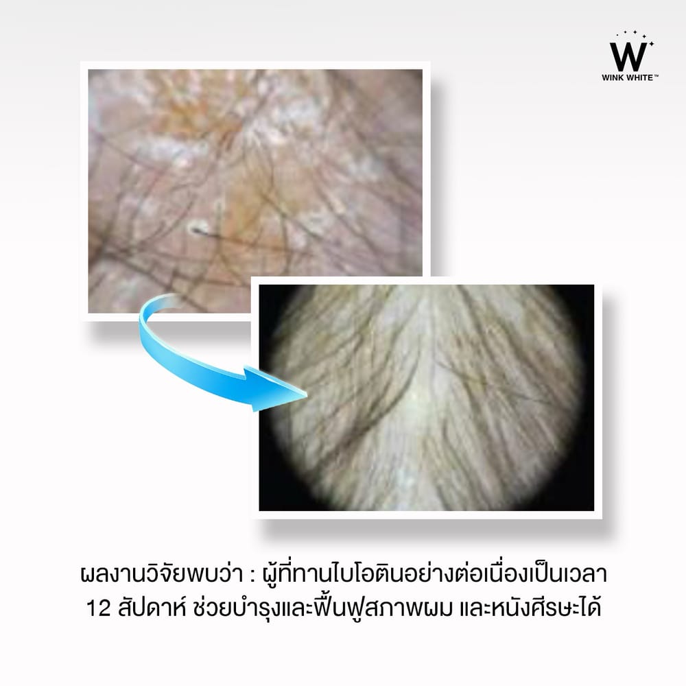 ไบโอติน วิงค์ไวท์ wink white วิ้งไวท์ ผมร่วง ผมบาง ฟื้นฟูผม ปลูกผม ผมสวย ปัญหา เส้นผม